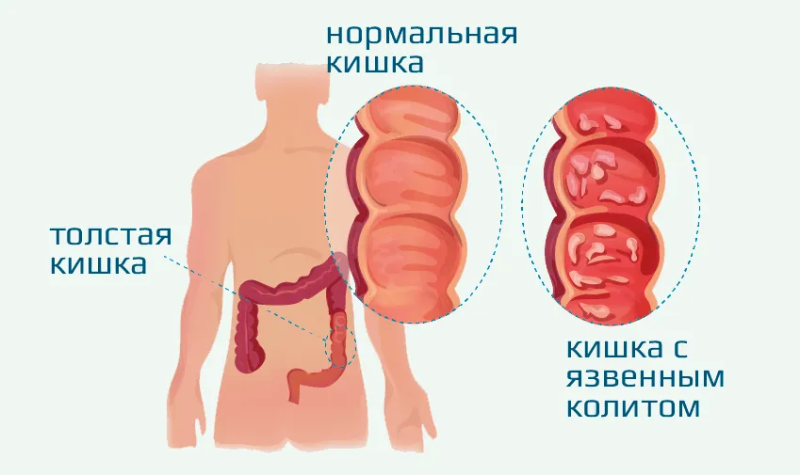 Язвенный колит 