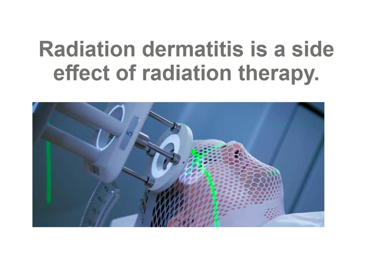 Radiation dermatitis Radiation dermatitis