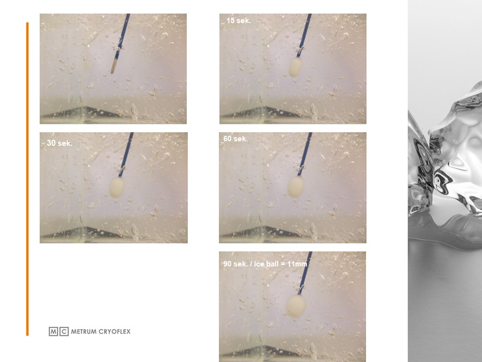 CRYOABLATION OF PENILE NERVES FOR PREMATURE EJACULATION TREATMENT: HOW IT WORKS AND WHY IT’S SAFE.