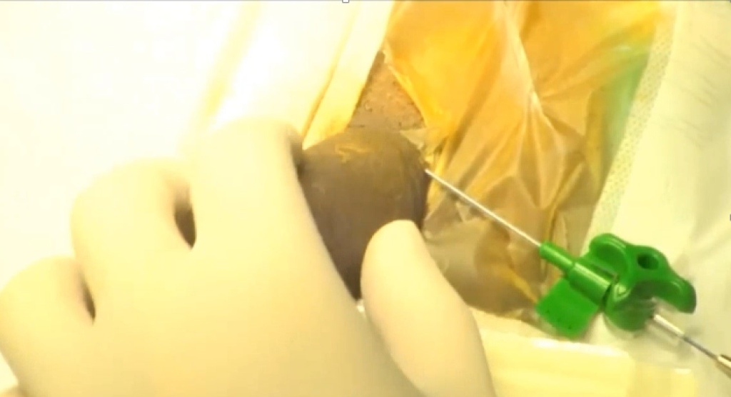 Selective Minimally Invasive Cryoablation as a Treatment for Premature Ejaculation