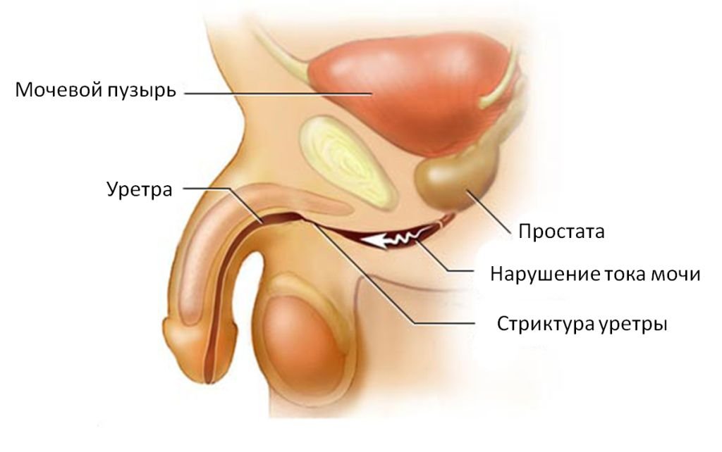 Стриктура – сужение уретры.