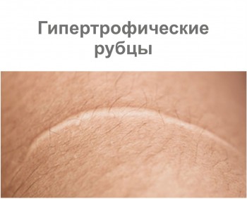 Гипертрофические шрамы Гипертрофические шрамы