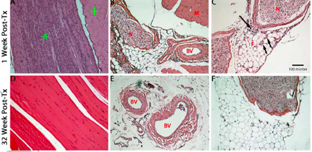 Selective Minimally Invasive Cryoablation as a Treatment for Premature Ejaculation