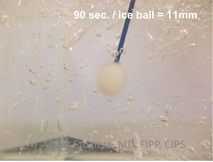 Selective Minimally Invasive Cryoablation as a Treatment for Premature Ejaculation
