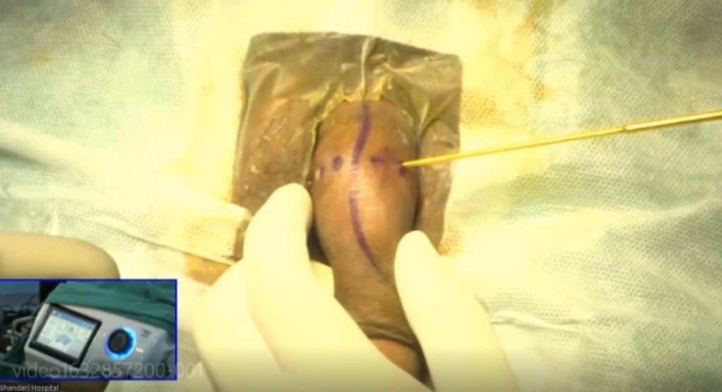 Selective Minimally Invasive Cryoablation as a Treatment for Premature Ejaculation