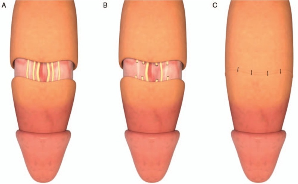 CRYOABLATION OF PENILE NERVES FOR PREMATURE EJACULATION TREATMENT: HOW IT WORKS AND WHY IT’S SAFE.