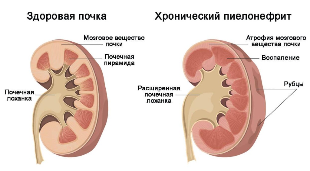 Пиелонефрит 
