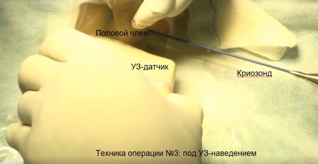 Selective Minimally Invasive Cryoablation as a Treatment for Premature Ejaculation