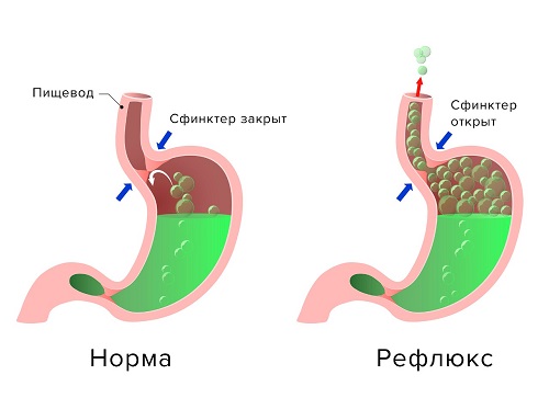 рефлюкс