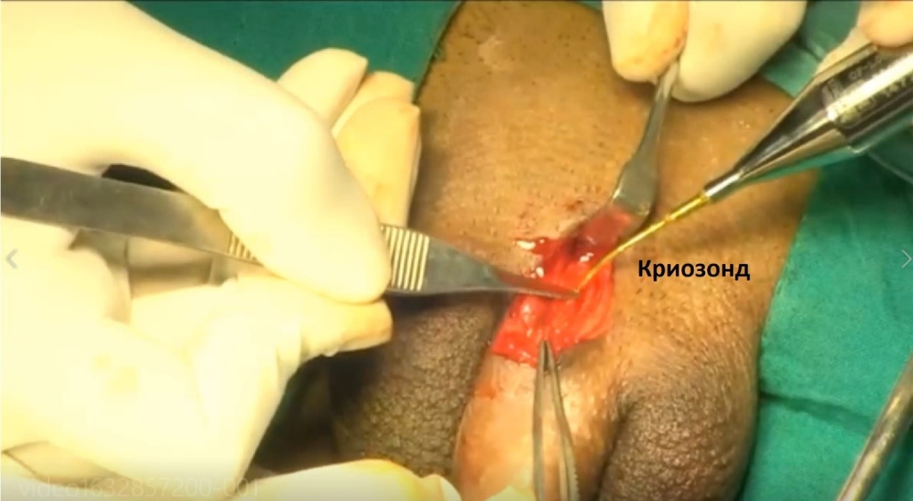Selective Minimally Invasive Cryoablation as a Treatment for Premature Ejaculation