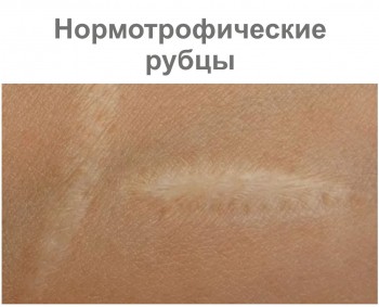 Нормотрофические рубцы Нормотрофические рубцы