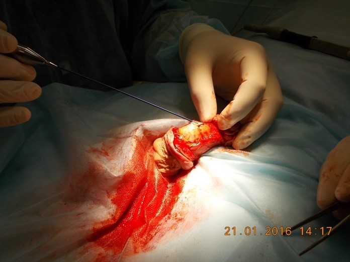Selective Minimally Invasive Cryoablation as a Treatment for Premature Ejaculation