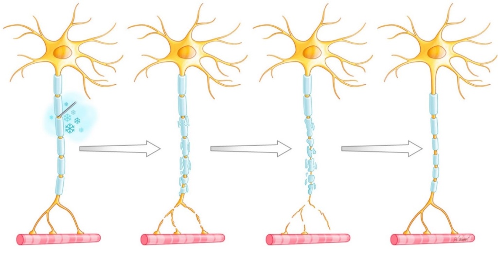 Selective Minimally Invasive Cryoablation as a Treatment for Premature Ejaculation