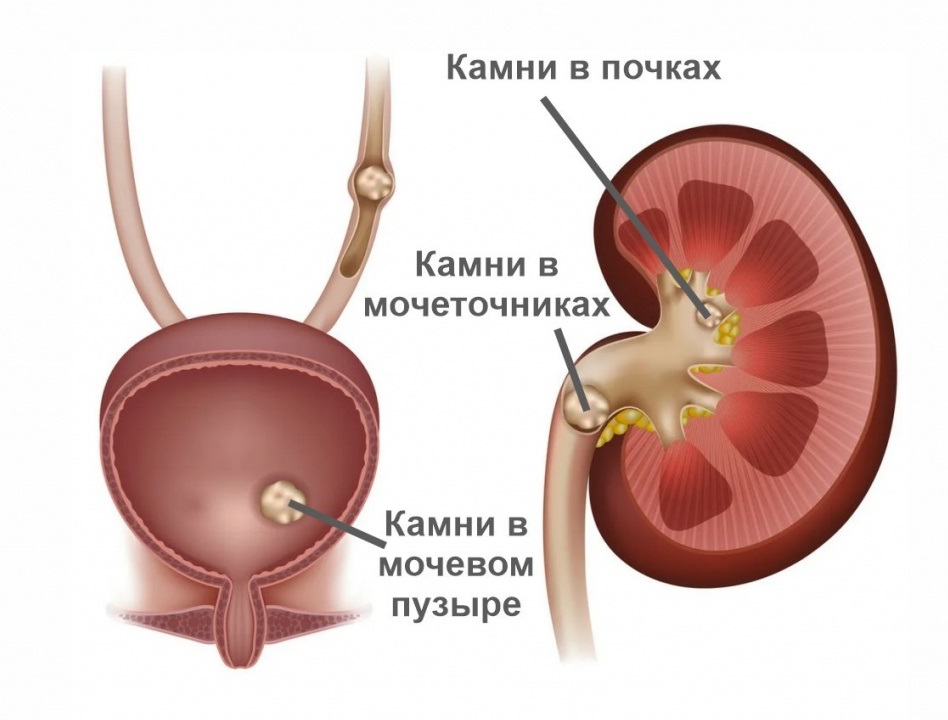  Мочекаменная болезнь: 