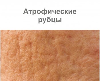 Атрофические рубцы Атрофические рубцы