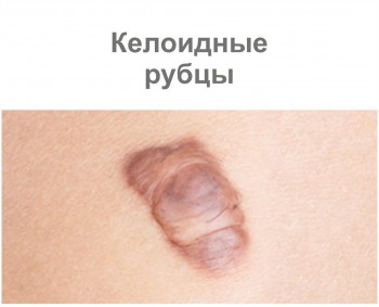 Келоидные рубцы Келоидные рубцы